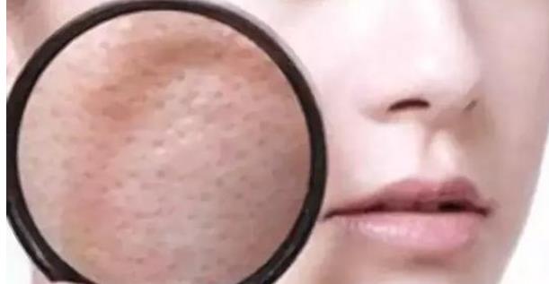 怎么改善油性皮肤毛孔粗大？