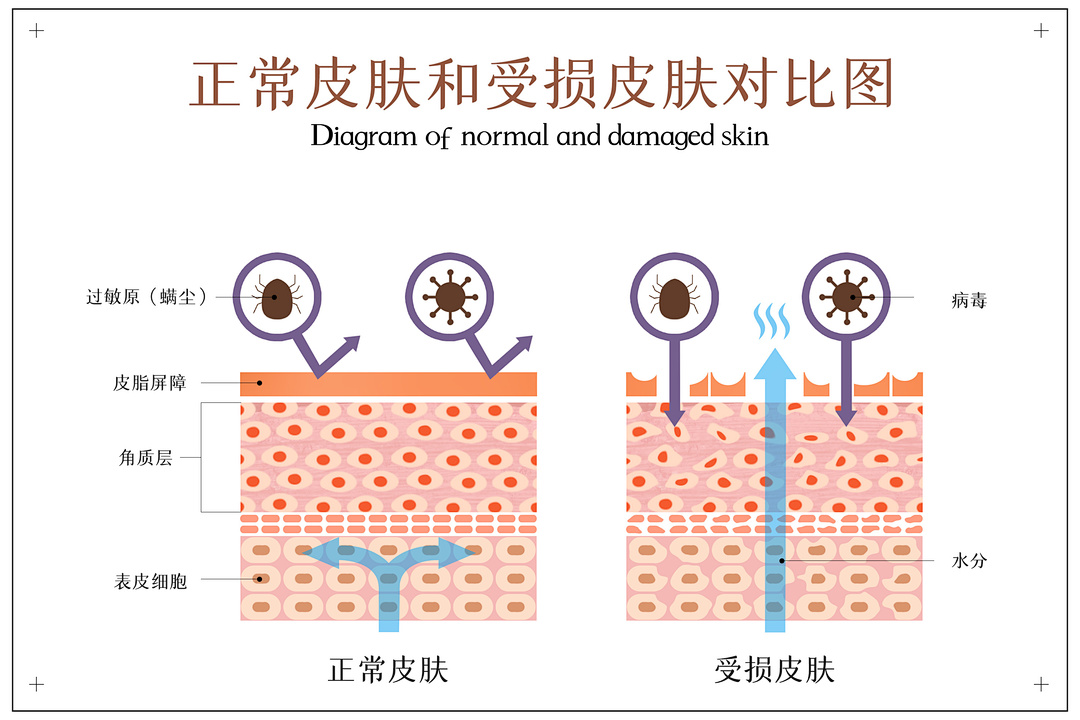 摄图网_401803348_正常皮肤和受损皮肤对比示意图（企业商用）.jpg